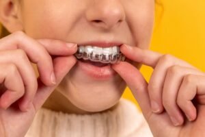 Clear Aligners for Misaligned Teeth: What Actually Moves a Tooth